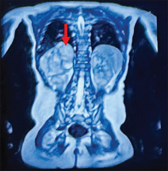 Anesthetic management of neuroblastoma excision in child with Kinsbourne syndrome.