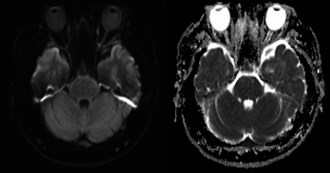 Acute unilateral visual loss as a first presentation of mixed phenotype acute leukaemia.
