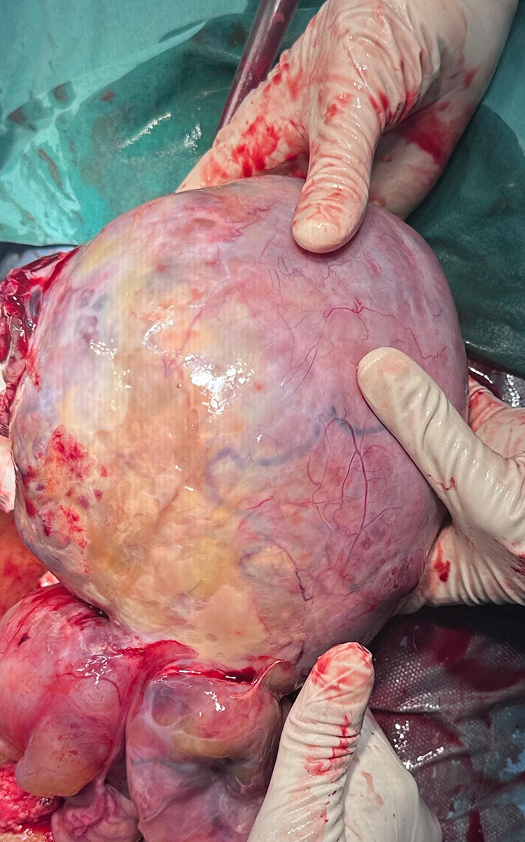 Ovarian Yolk Sac Tumor in a Young Girl in a Resource-Limited Setting: A Rare Case Report From Somalia.
