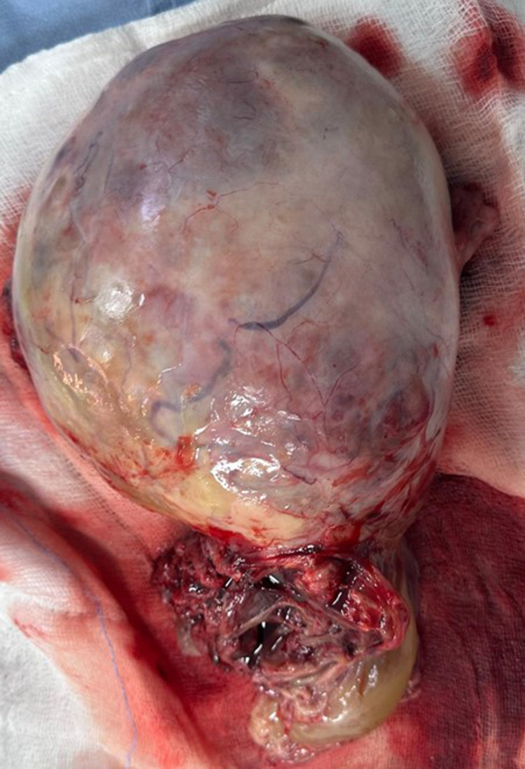 Ovarian Yolk Sac Tumor in a Young Girl in a Resource-Limited Setting: A Rare Case Report From Somalia.