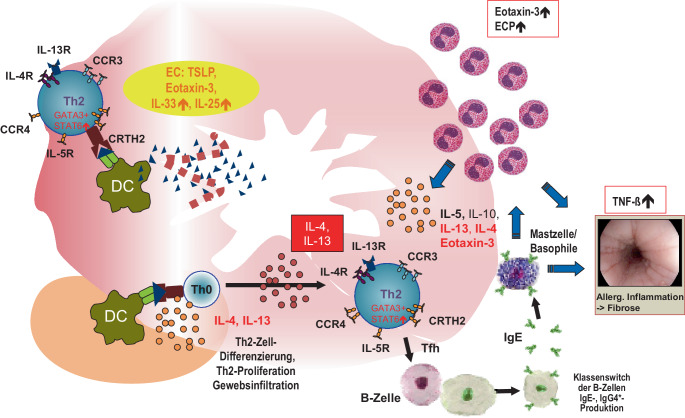 [Eosinophilic esophagitis-an underestimated food allergy?]