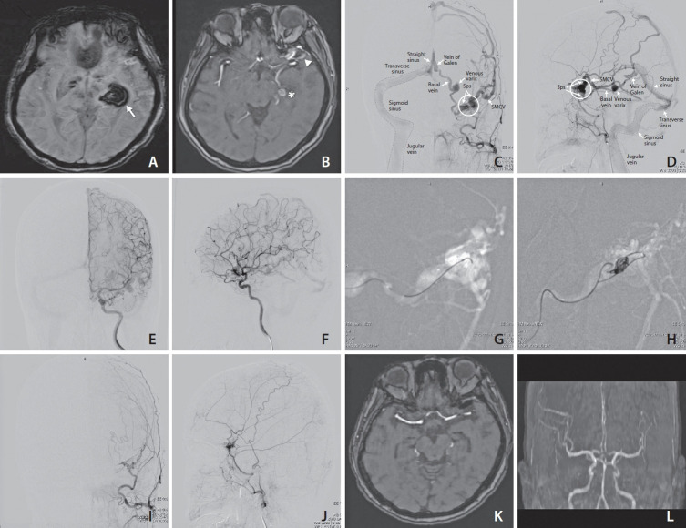 Trans-Galen Approach for Embolization of Sphenoparietal Sinus Dural Arteriovenous Fistulas.