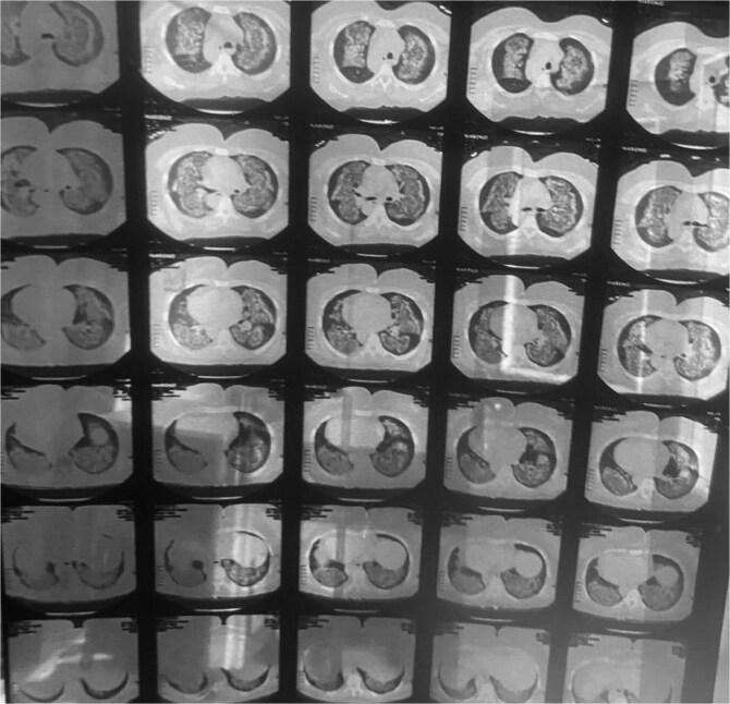 Diffuse alveolar Hemorrhage as the initial presentation of systemic lupus erythematosus in a 57-year-old patient: a case report.