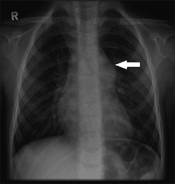 Anesthetic management of chronic thromboembolic pulmonary hypertension for surgical pulmonary thromboendarterectomy: A narrative review.