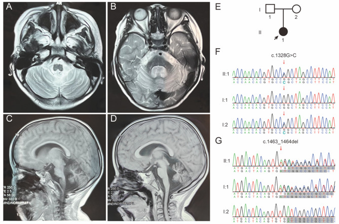 Identifying compound heterozygous variants in the EEFSEC gene linked to progressive cerebellar atrophy.