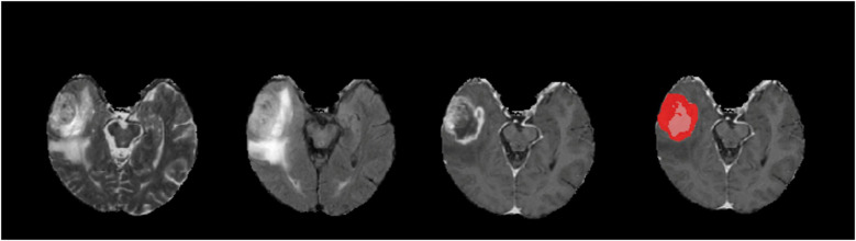 Brain tumor segmentation using deep learning: high performance with minimized MRI data.