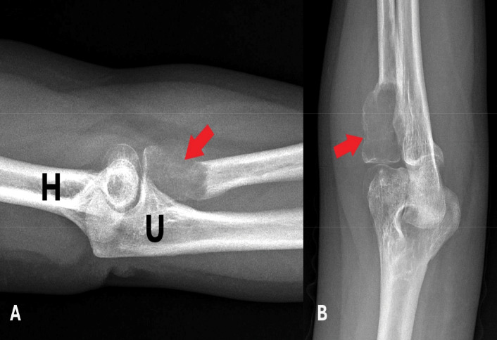 A Rare Subtype in an Uncommon Location: Multimodal Radiologic and Histopathologic Evaluation of a Solid Variant Aneurysmal Bone Cyst in the Radial Head.