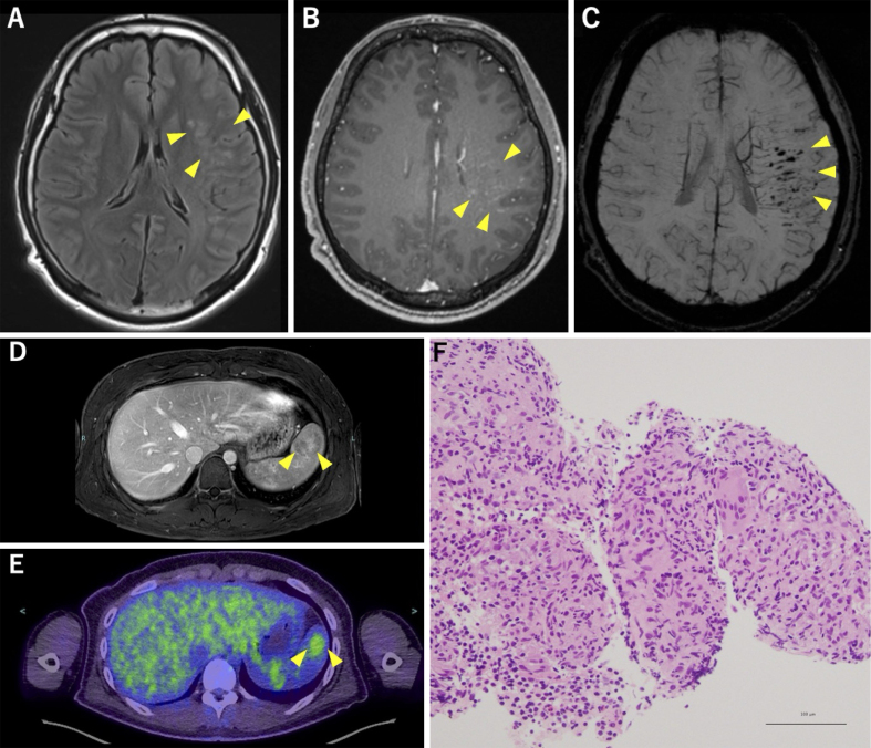 Neurosarcoidosis Limited to the Central Nervous System and Spleen, Presenting with Episodic Nonfluent Aphasia.