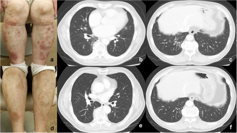 Deucravacitinib Improved Interstitial Pneumonia Along with KL-6 Reduction in a Patient with Psoriasis: A Case Report.