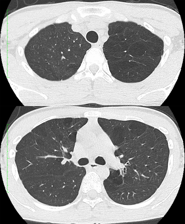 A Case of Asymptomatic Juvenile Emphysema.