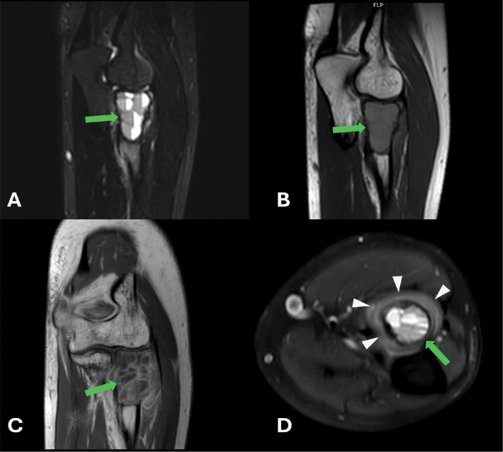 A Rare Subtype in an Uncommon Location: Multimodal Radiologic and Histopathologic Evaluation of a Solid Variant Aneurysmal Bone Cyst in the Radial Head.