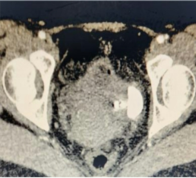 Vesicouterine fistula with vesical calculi secondary to IUD migration: a case report.
