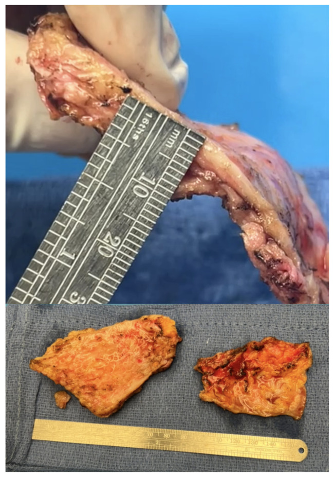 The Heart of the Matter: A Case of Massive Pedal Edema Erroneously Attributed to Liver Cirrhosis.