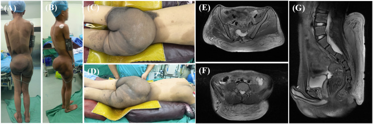 Surgical management of giant neurofibroma in a pediatric patient: A case report.