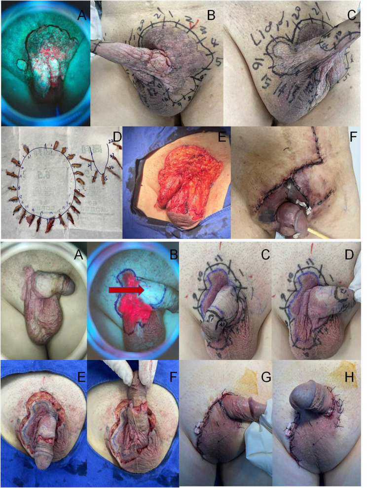 Narrow-Margin Treatment with Modified Mohs Microsurgery for Extramammary Paget's Disease: A Retrospective Clinical Analysis.