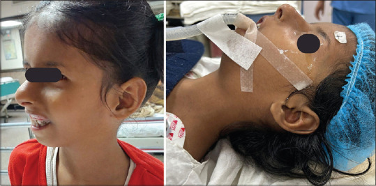 A rare encounter: Navigating airway challenges in Van den Ende-Gupta syndrome.