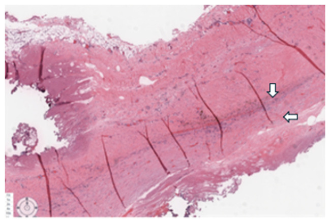 The Heart of the Matter: A Case of Massive Pedal Edema Erroneously Attributed to Liver Cirrhosis.