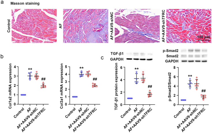 Transferrin receptor knockdown attenuates atrial fibrillation by inhibiting cardiomyocyte ferroptosis and atrial fibrosis.