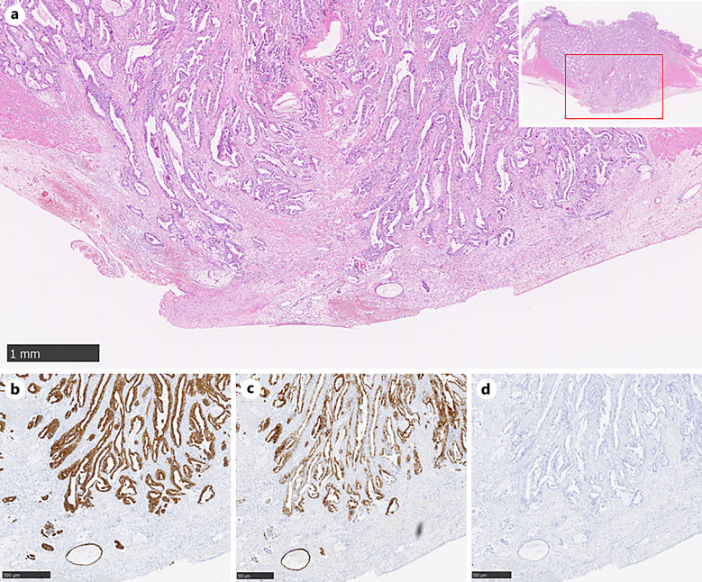 Small Duodenal Adenocarcinoma with Peritoneal Dissemination Mimicking Duodenal Brunner's Gland Hyperplasia.