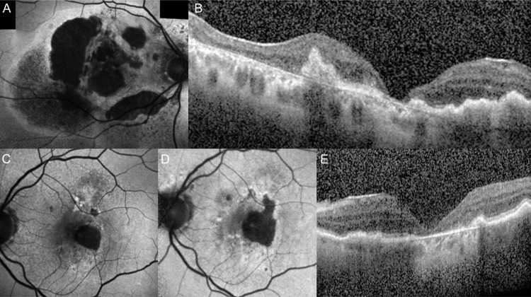 Consideration of patient phenotypes in geographic atrophy due to age-related macular degeneration.