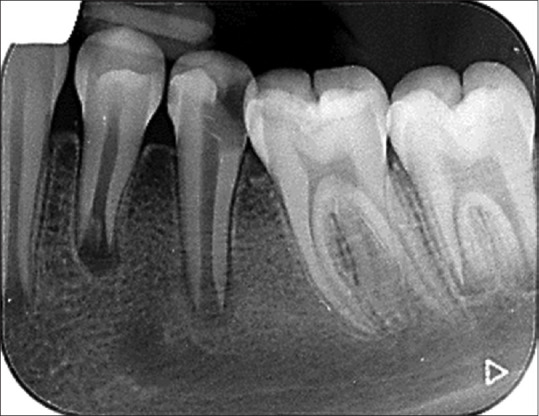 Root development of immature necrotic permanent teeth following regenerative endodontic process: Case series.