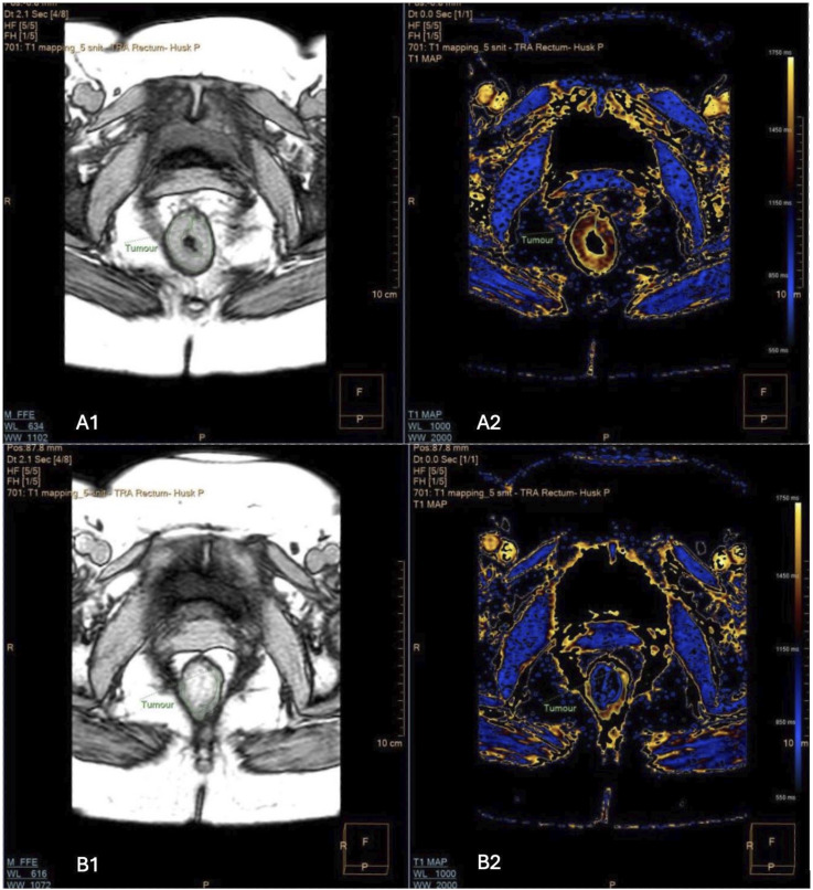 MRI T1 relaxation time for evaluating early complete response to neoadjuvant treatment in rectal cancer: measurement at six weeks - a protocol article.