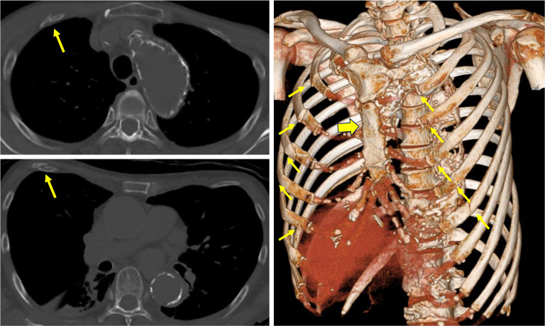 Application of the Nuss procedure for flail chest following cardiopulmonary resuscitation: a case report.