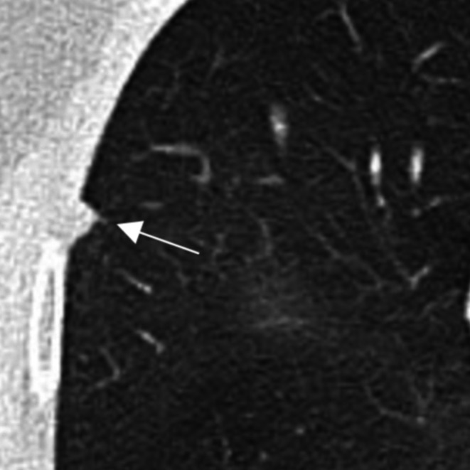 The TSANZ Practical Guide for Clinicians in the Management of Screen- and Incidentally-Detected Nodules.
