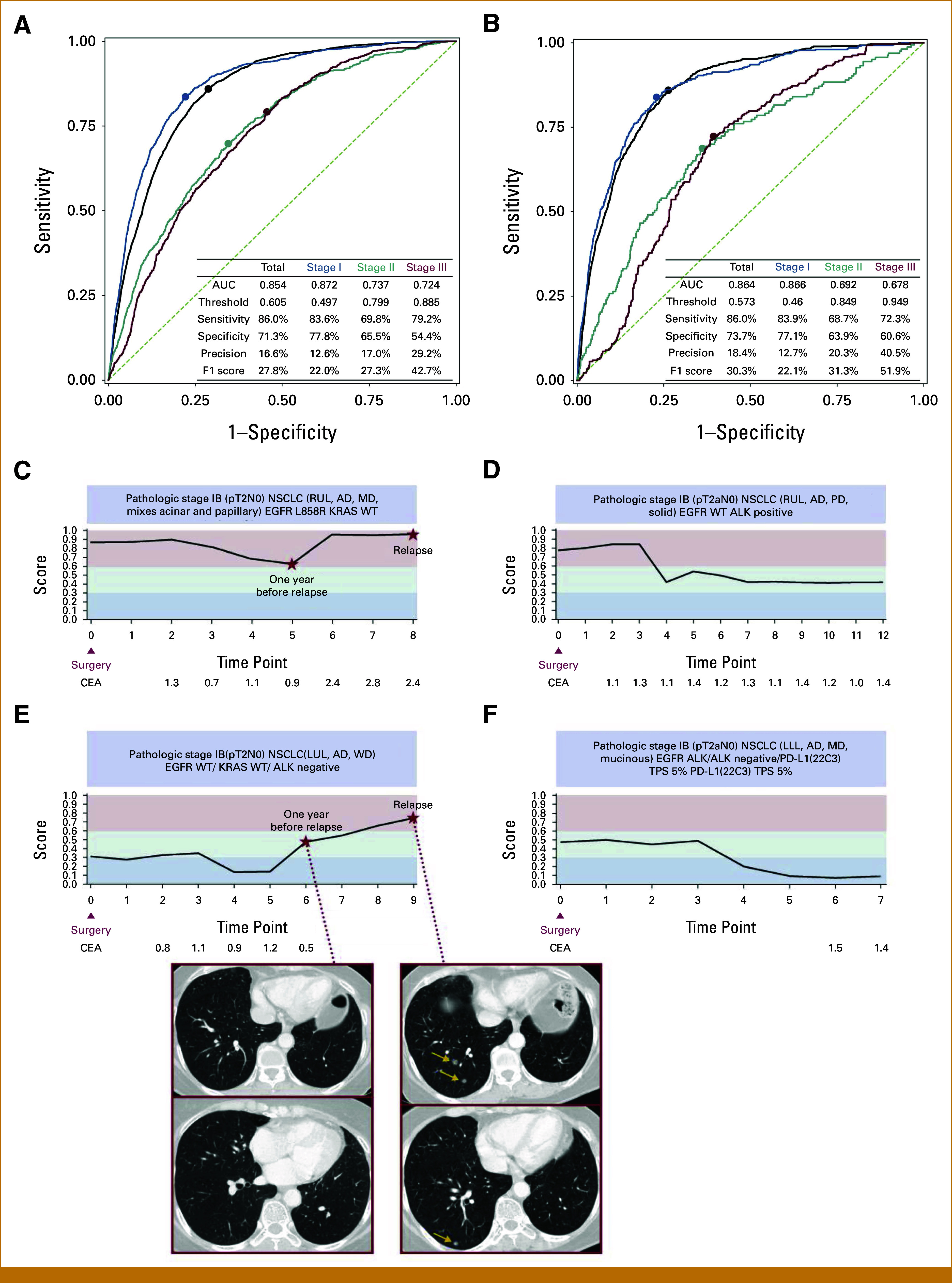 Deep-Learning Model for Real-Time Prediction of Recurrence in Early-Stage Non-Small Cell Lung Cancer: A Multimodal Approach (RADAR CARE Study).