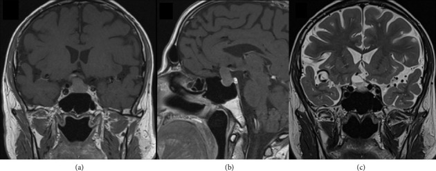 A Medical Rarity: Isolated <i>Toxoplasma gondii</i> Abscess in the Pituitary Gland of an Immunocompetent Patient.