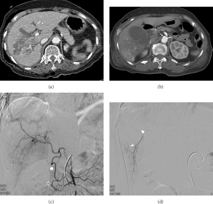 Efficacy of Transcatheter Arterial Embolization for Hemorrhage Control in Traumatic Hepatic Injury With Celiac Axis Stenosis.
