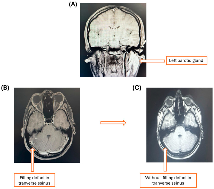 Psychotic Disorder Secondary to Cerebral Venous Thrombosis Caused by Primary Thrombophilia in a Pediatric Patient with Protein S Deficiency and an MTHFR p.Ala222Val Variant: A Case Report.