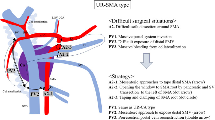 Standardization of surgical procedure for initially unresectable locally advanced pancreatic head cancer.