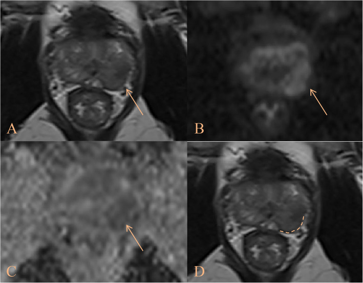 Development and validation of a novel clinical-radiological-pathological scoring system for preoperative prediction of extraprostatic extension in prostate cancer: a multicenter retrospective study.