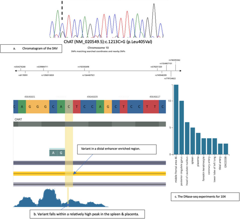 The identification of novel missense variant in <i>ChAT</i> gene in a patient with gestational diabetes denotes plausible genetic association.