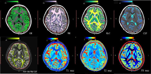Assessing grey matter structural alterations in systemic lupus erythematosus using synthetic MRI.