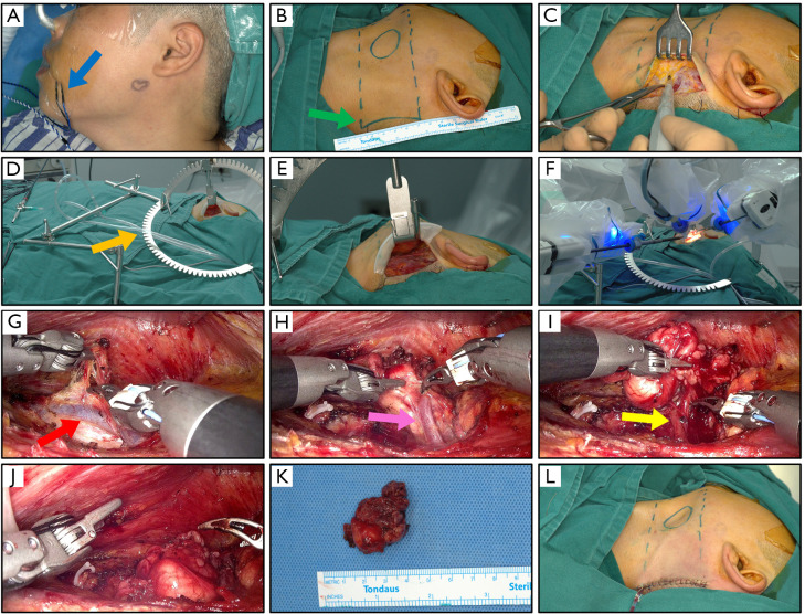 Evaluation of a new developed robotic system for head and neck surgery: a prospective study.