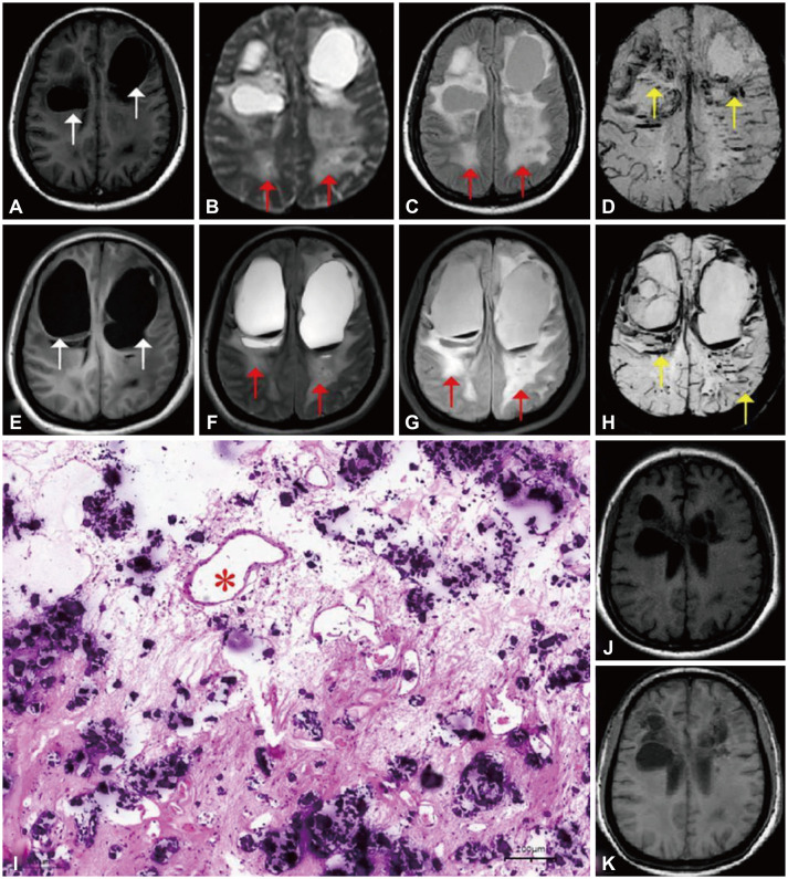 Leukoencephalopathy With Cerebral Calcifications and Cysts With Novel <i>SNORD118</i> Mutations Presenting With Bilateral Giant Cysts.