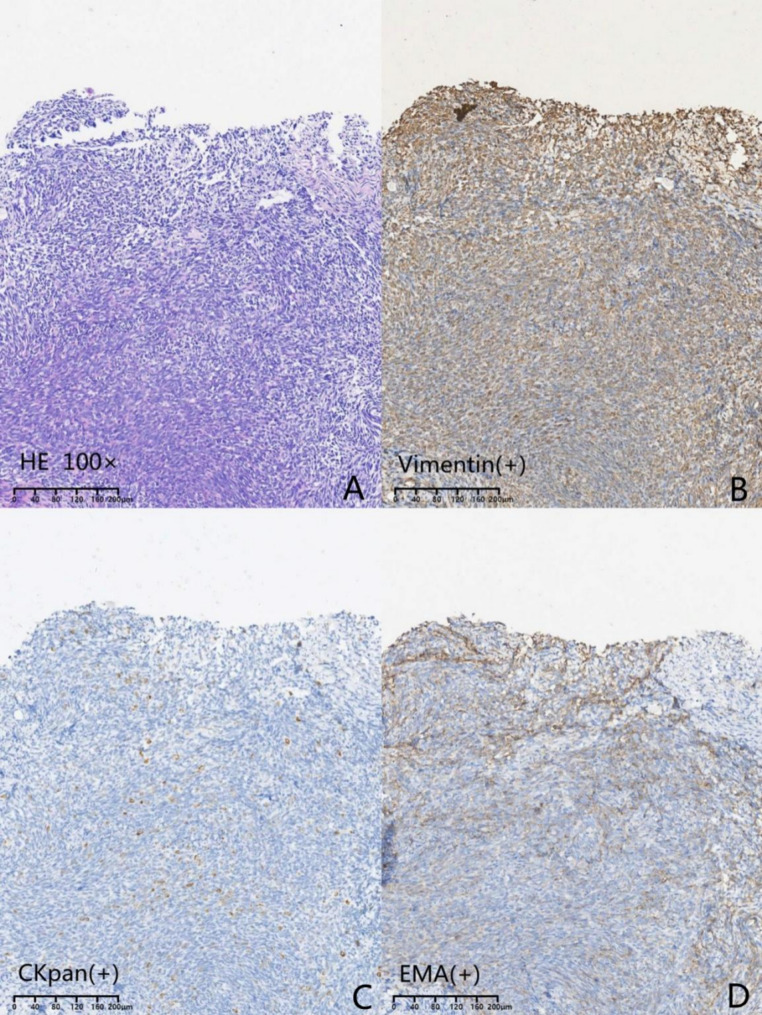 A case of primary tarsal sinus synovial sarcoma.