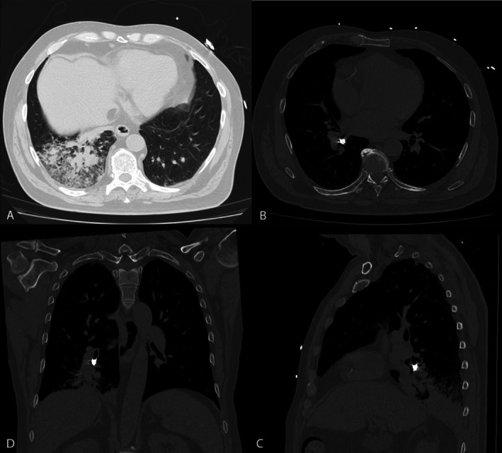 A Crumpet, a Canine and a Cryoprobe: A Case of Tooth Aspiration.