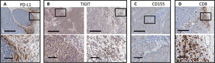 Inhibitory Immune Checkpoints beyond Programmed Cell Death Ligand 1 in Merkel Cell Carcinoma: Abundant Expression of TIGIT Independent of the Presence of Merkel Cell Polyoma Virus.