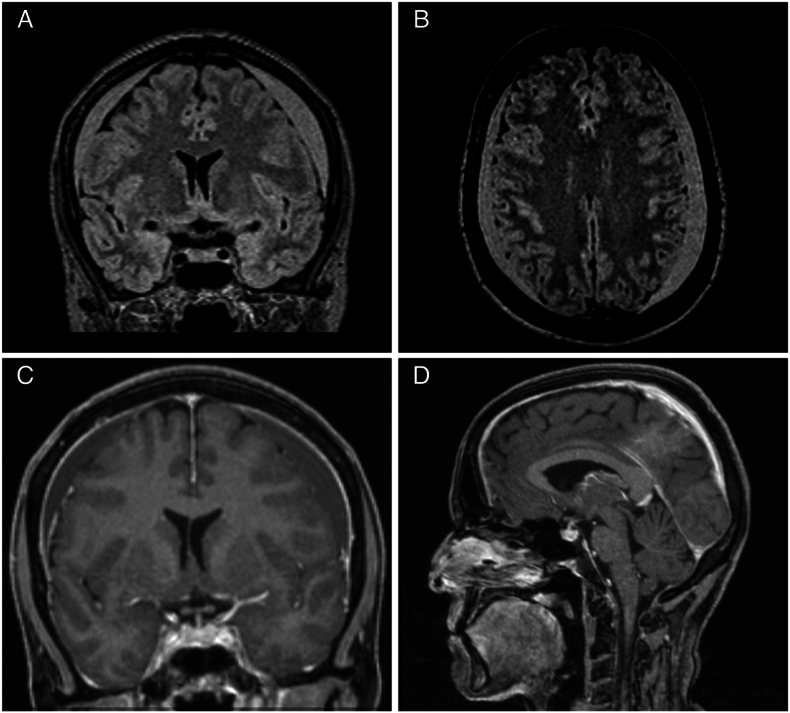 Management of chronic subdural hematoma in spontaneous intracranial hypotension.
