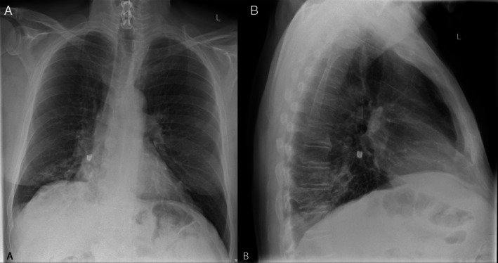 A Crumpet, a Canine and a Cryoprobe: A Case of Tooth Aspiration.