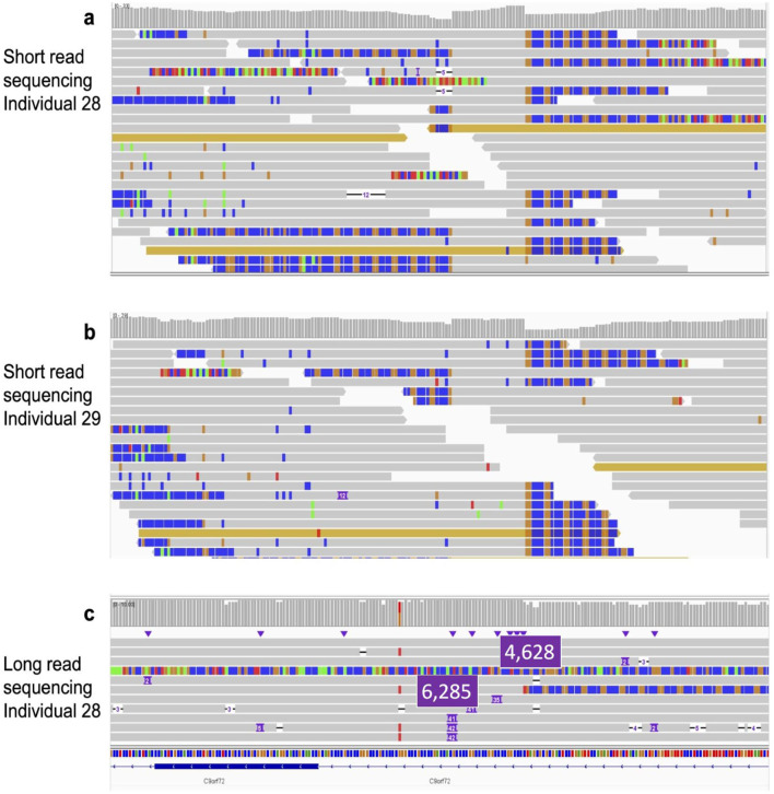 Comprehensive identification of pathogenic tandem repeat expansions in sporadic amyotrophic lateral sclerosis: advantages of long-read vs. short-read sequencing.