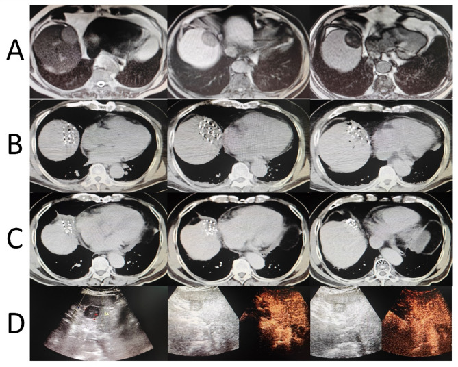 Investigation into the efficiency and prognostic elements of CT-guided ¹²⁵I particle implantation for liver cancer.