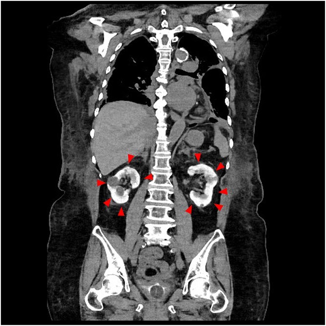 Bright kidney: a sign of contrast induced nephropathy after percutaneous coronary intervention.