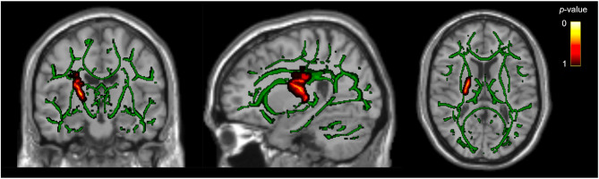 White matter tract differences in persistent post-traumatic headache, migraine, and healthy controls: a diffusion tensor imaging study.