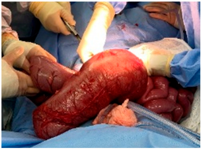 A Case Report of a Child with Constipation Diagnosed with Acquired Myenteric Hypoganglionosis.