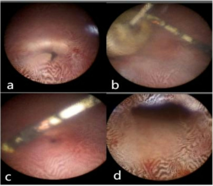 Vesicouterine fistula with vesical calculi secondary to IUD migration: a case report.