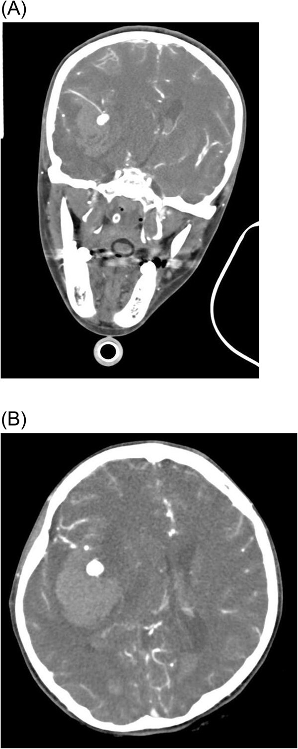 Ruptured intracranial Mycotic aneurysm following infective endocarditis in a young patient: a case report.